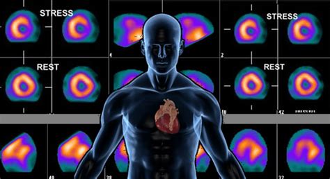 is a nuclear stress test hard on the kidneys|Nuclear Stress Tests: Uses, Risks, and Results.